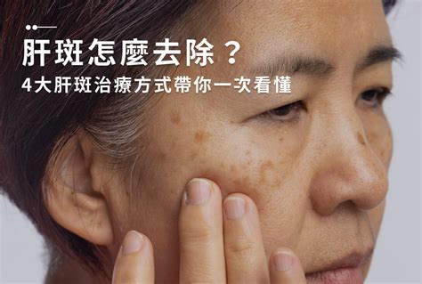 胸部下長斑|曬斑、肝斑、長斑怎麼辦？有效淡化斑點5個方法：淡。